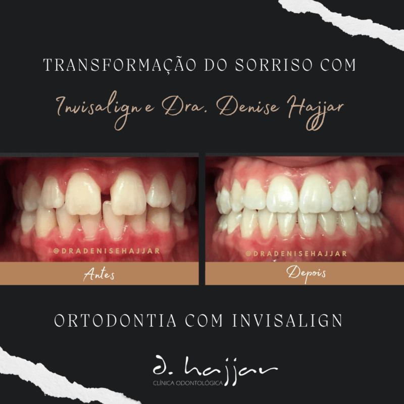 Odontologia Estetica Ortodontia com Invisalign