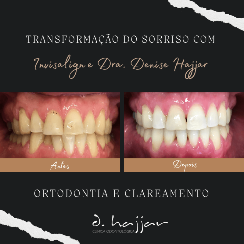 Odontologia Estetica Ortodontia e Clareamento
