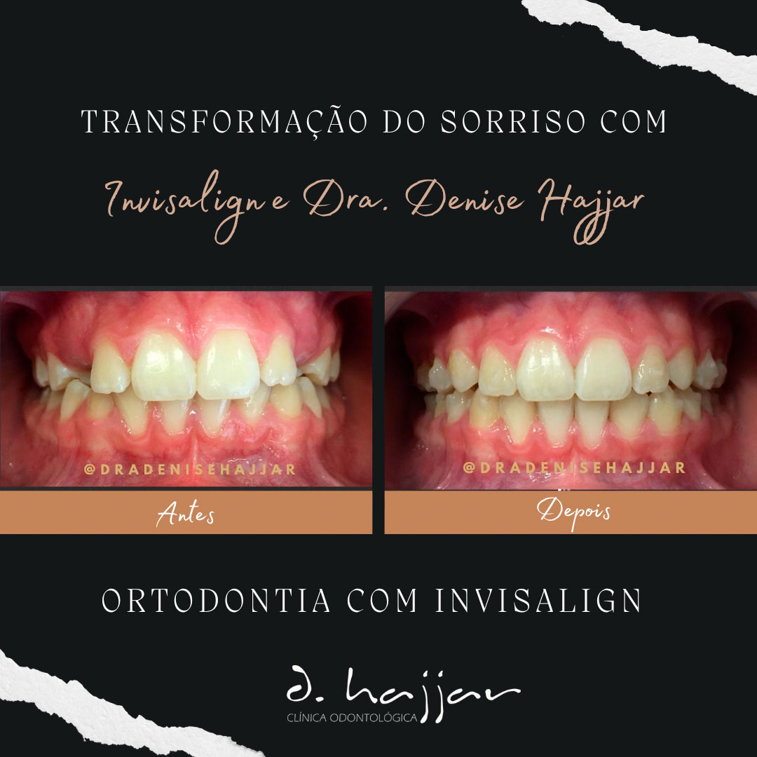 resultado das etapas do tratamento ortodontico com Invisalign